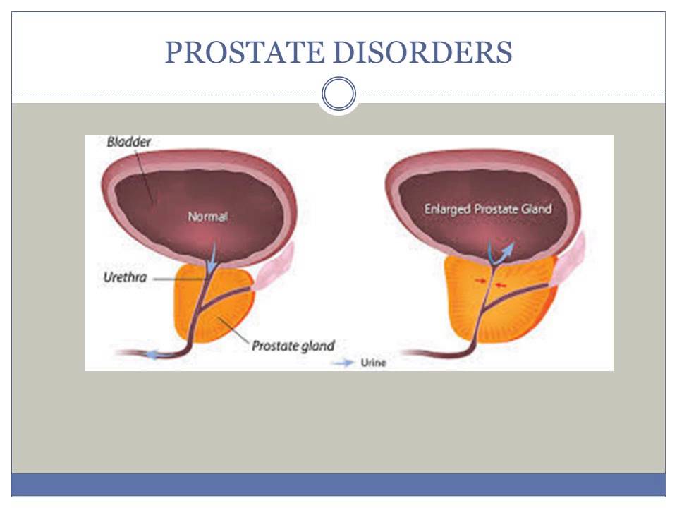 PROSTATE DISORDERS