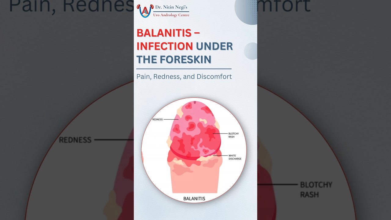 What Is Balanitis? Painful Foreskin Infection Explained | Best Urologist || Dr Nitin Negi #shorts