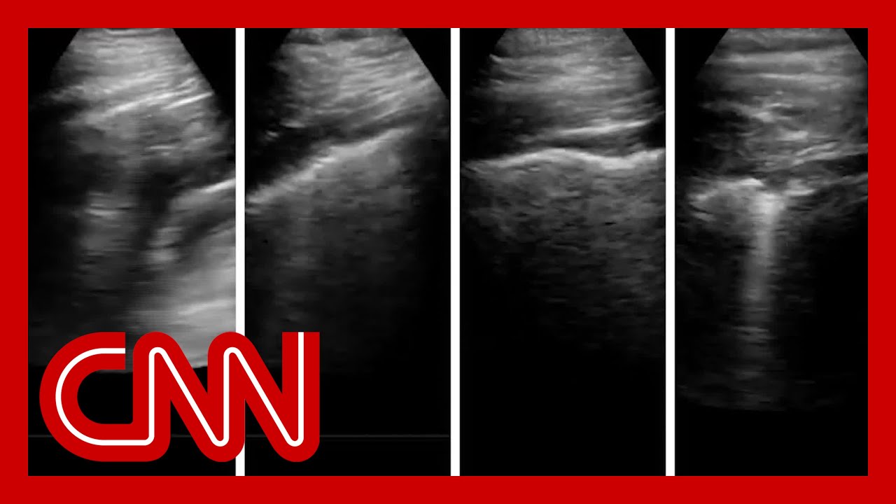 Doctor ultrasounds his lungs as his coronavirus progresses