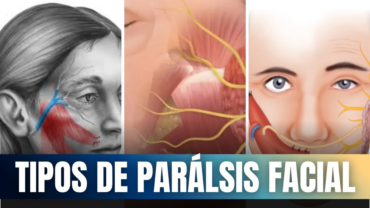 TRES TIPOS de PAR&Aacute;LISIS FACIAL I MAVIR BIOFEEDBACK