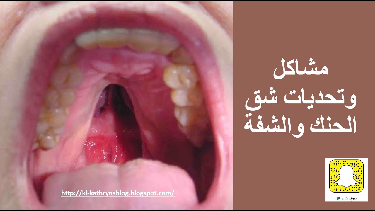 ماهي مشاكل وتحديات شق الحنك والشفة؟