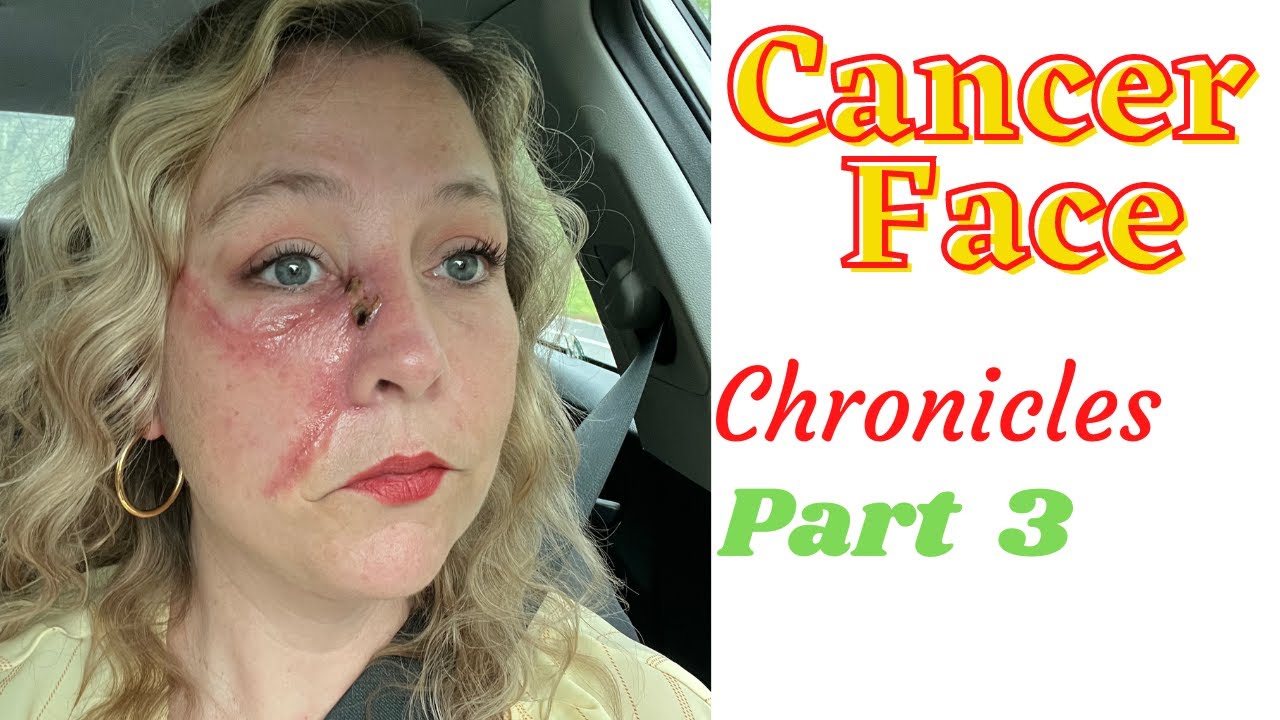 Cancerface Chronicles 3: Scars. Love Them or Cover Them?