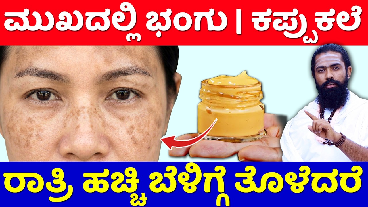 ಈ ಕ್ರೀಮ್ ಹಚ್ಚಿದರೆ ಭಂಗು / ಕಪ್ಪುಕಲೆ ಮಾಯ | Pigmentation Treatment on Face Kannada | Bhangu Kannada