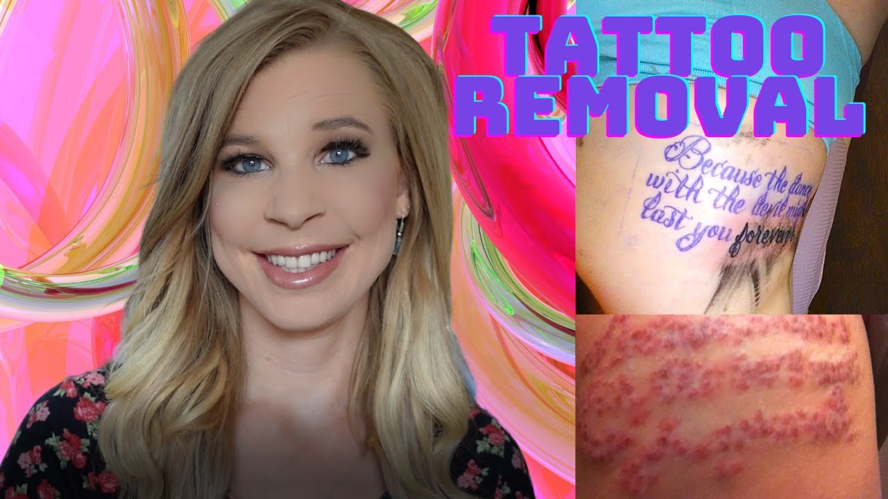 Do I regret getting my tattoo removed? Plus how long it takes.