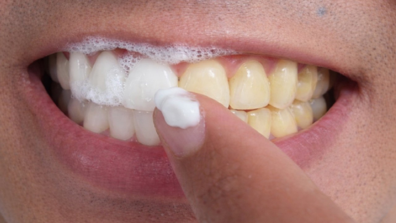 Morria e não sabia: DENTES BRANCOS em 2 minutos. Como clarear todos dentes amarelos em casa