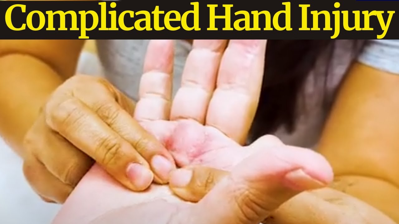 Tackling A Complicated Hand Injury & Finger Amputation & Fracture