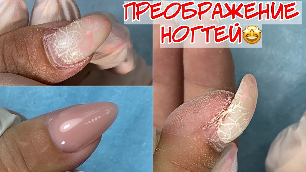 Преображение после травмы ногтя 🤕 Коррекция ногтей гелем 😍