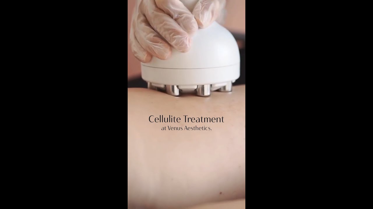 Cellulite Treatment: Discover Effective Solutions for Smoother Skin | Real Results 