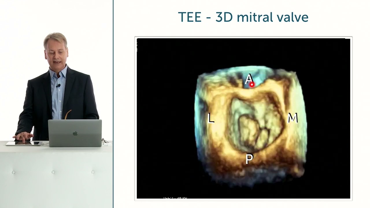 What is the surgical view of the Mitral valve?