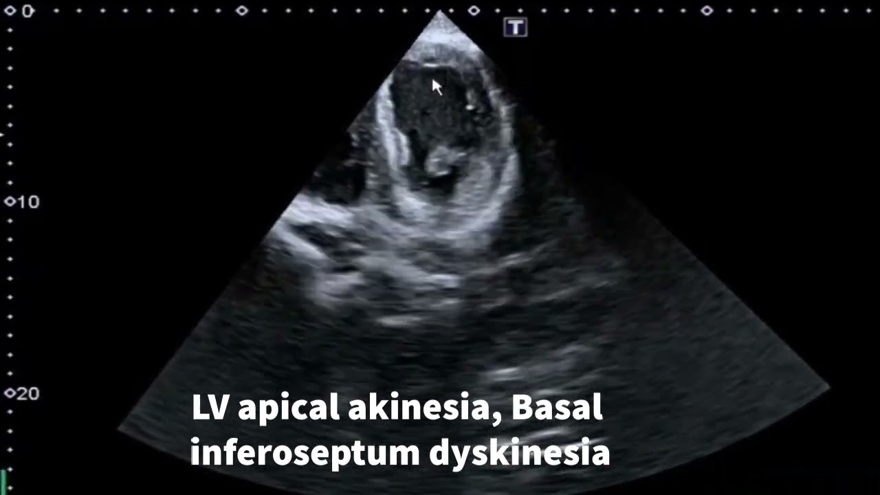 Akinesia,hypokinesia,dyskinesia,aneurysm