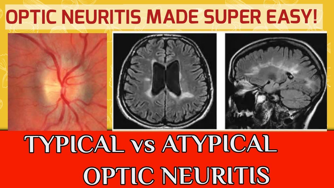 OPTIC NEURITIS || Typical optic neuritis and atypical optic neuritis