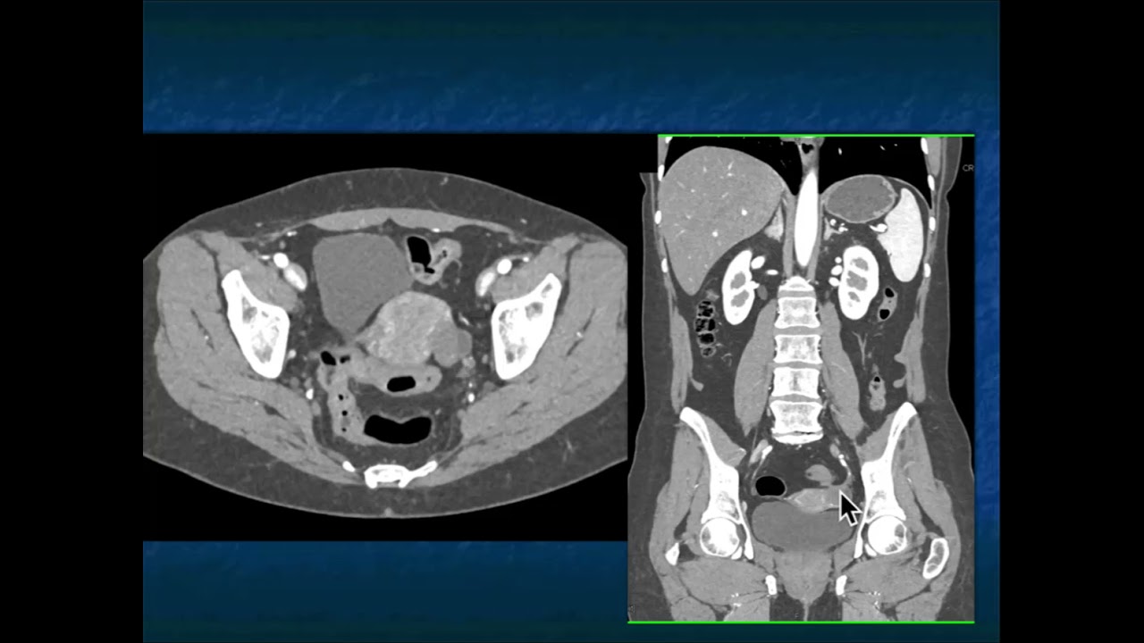 CT Evaluation of Endometriosis