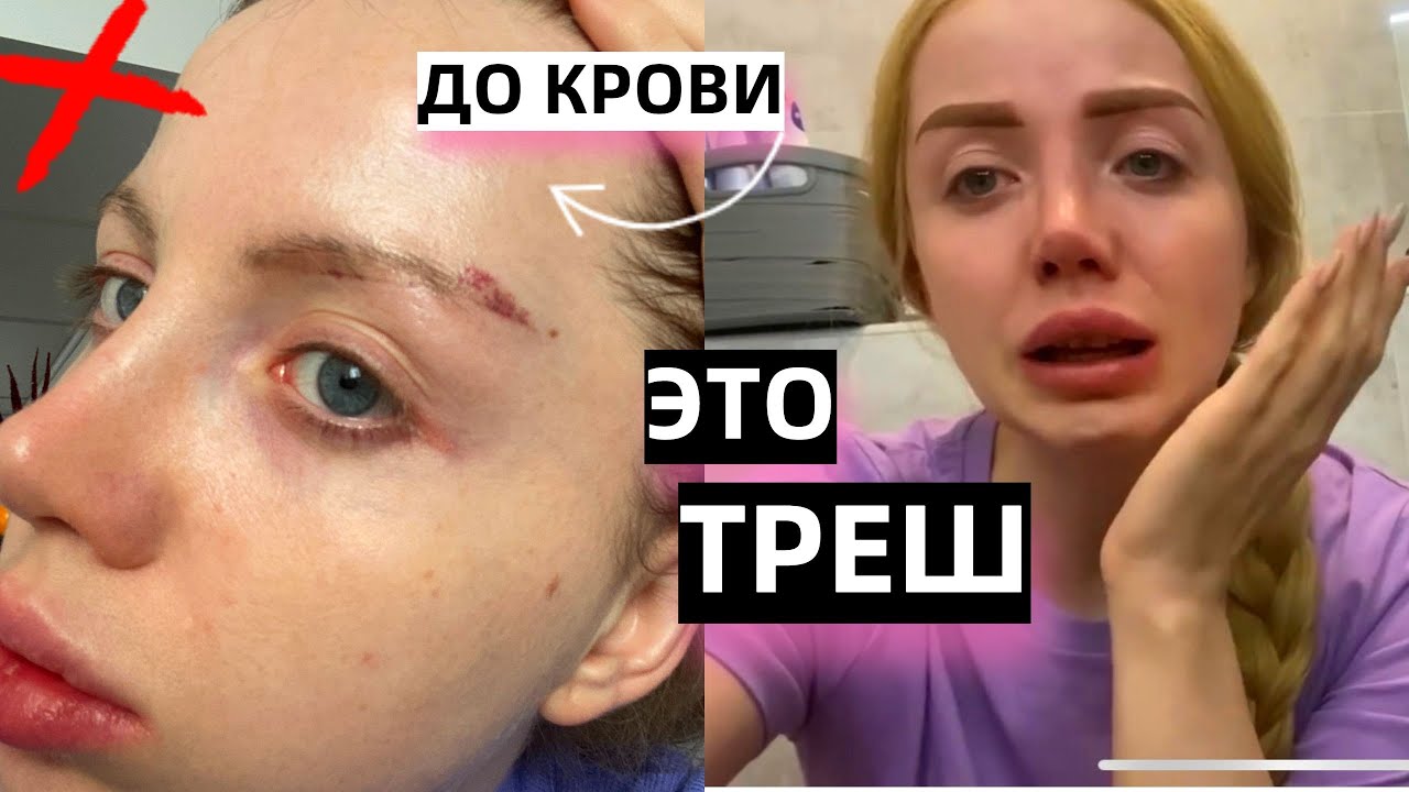 СО МНОЙ СЛУЧИЛСЯ ТРЕШ!!! УДАЛЯЮ ТАТУАЖ