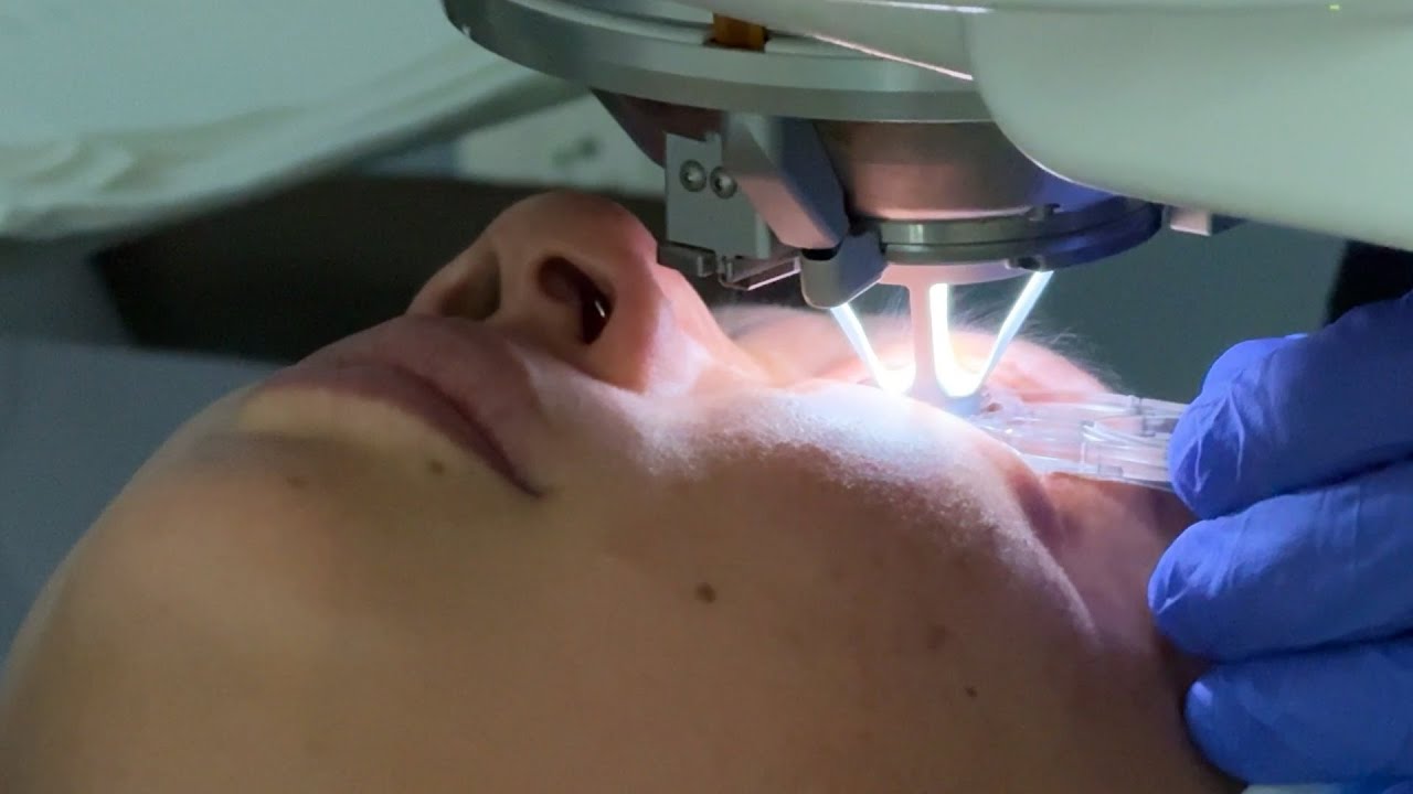 AI takes LASIK to the next level
