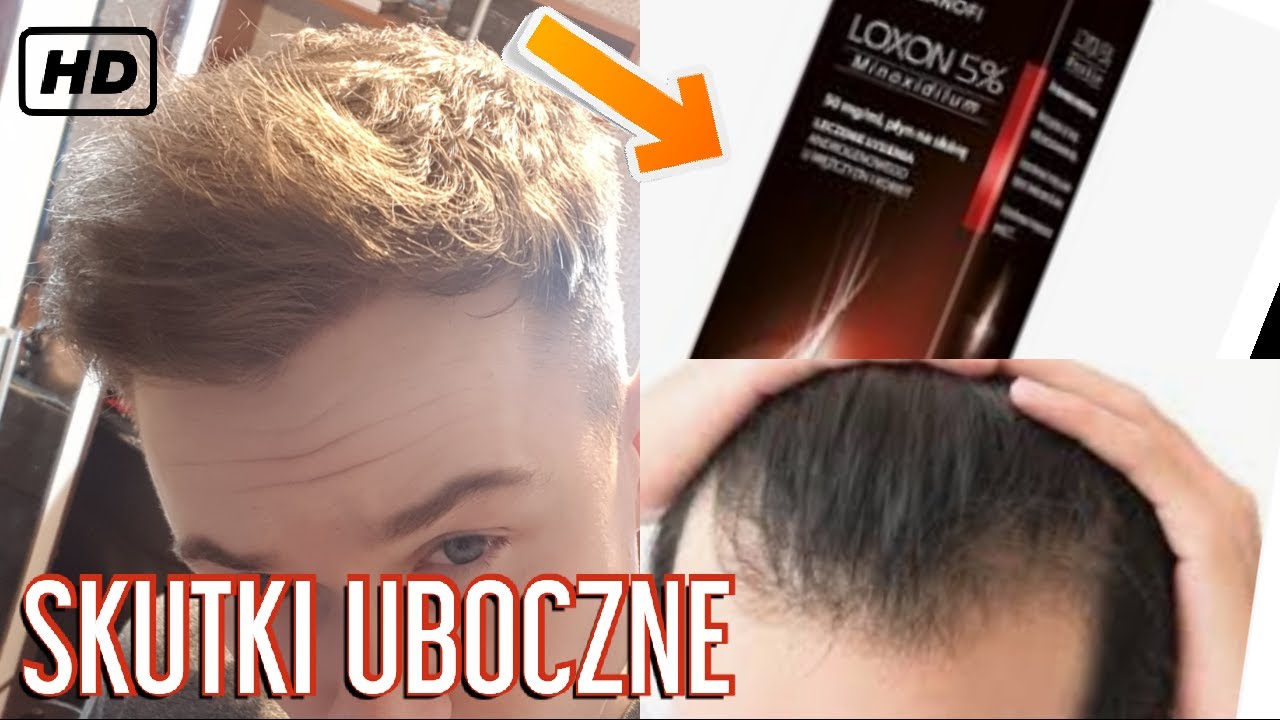 Włosy Minoksydyl Loxon Alocutan Skutki uboczne ZOBACZ!