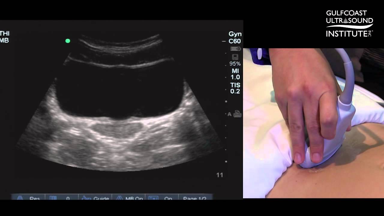 Hot Tips - Locating the Ovaries on Transabdominal Ultrasound