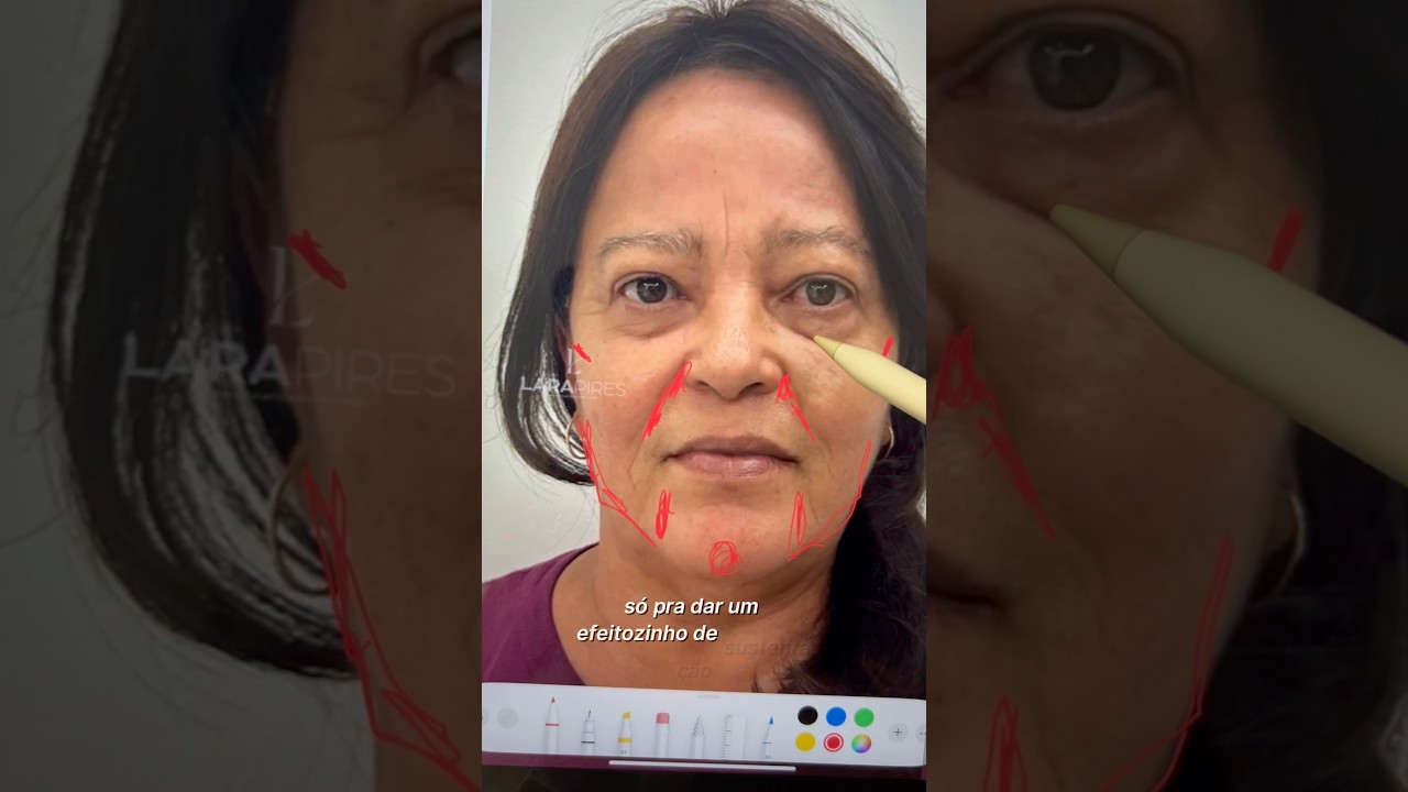 Antes e depois harmoniza&ccedil;&atilde;o facial fullface #hof #fullface #rejuvenescimentofacial #dermatosalvador