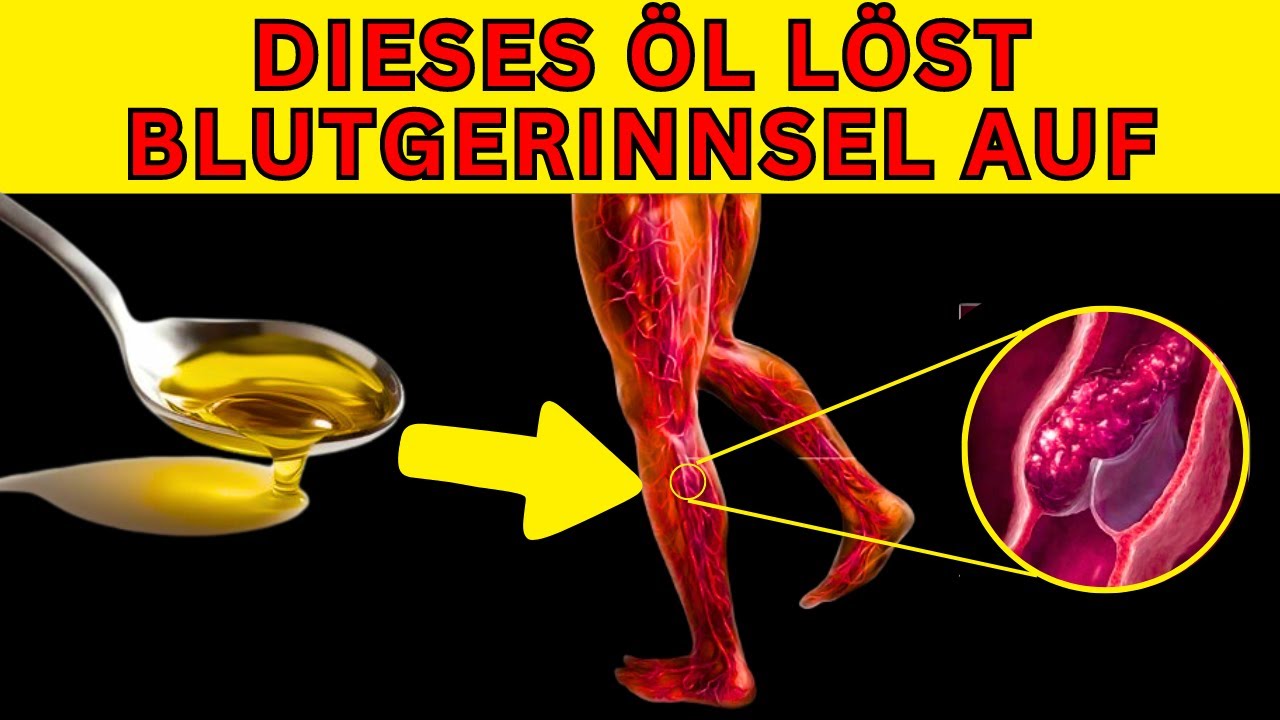 Blutgerinnsel auf nat&uuml;rliche Weise aufl&ouml;sen: Die 6 besten &Ouml;le