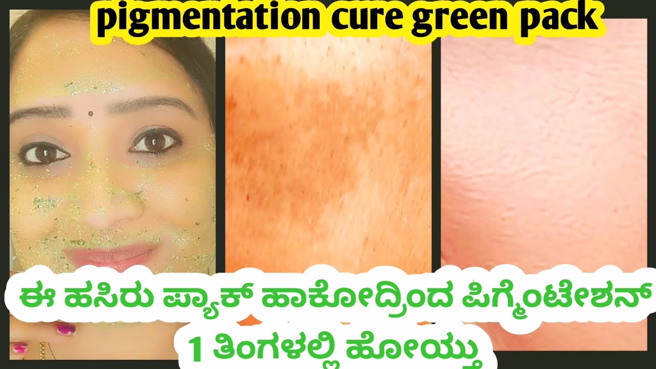 1 ತಿಂಗಳಲ್ಲಿ ಪಿಗ್ಮೆಂಟೇಶನ್ ಈ ಹಸಿರು ಪ್ಯಾಕ್ ನಿಂದ ಹೋಯ್ತು|pigmentation|tejujewelry|kannadavlogs 