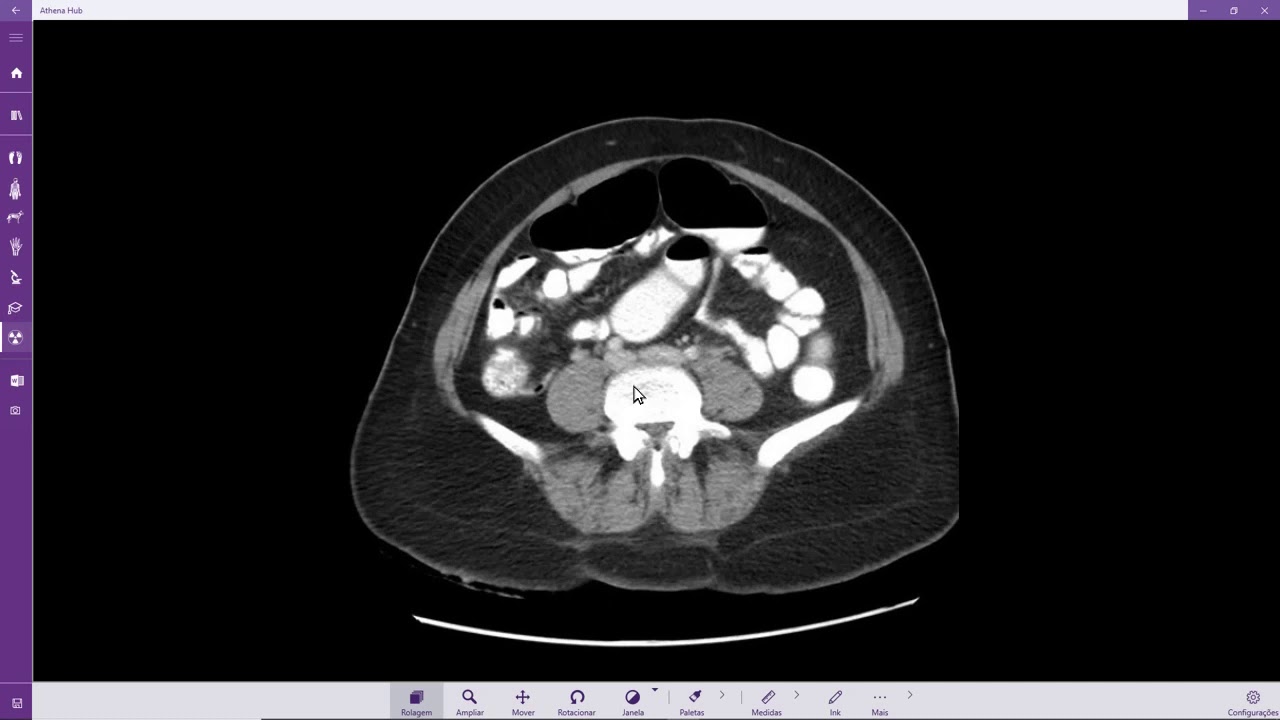 Diverticulite aguda