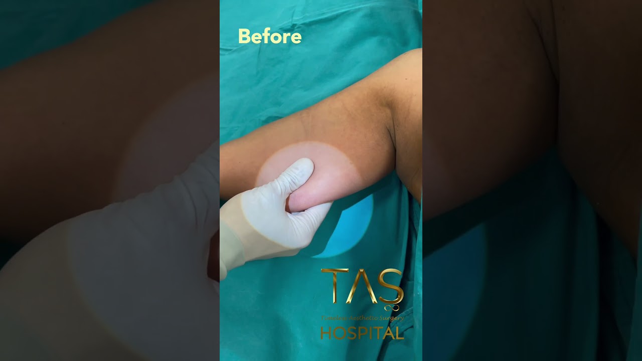 Scarless ArmLift by Dr.TAS