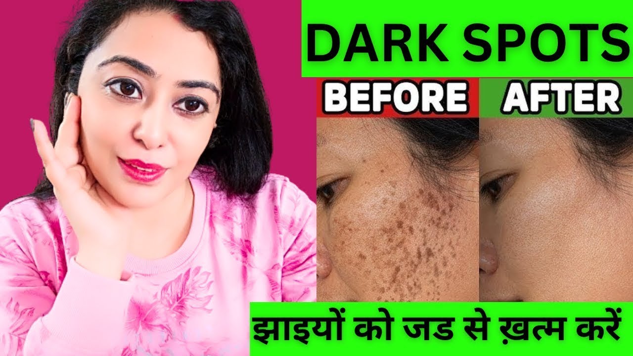 नारियल तेल में बस 1 चीज़ मिलने से झाइयाँ, dark spots को जड़ से ख़त्म करें Pigmentation Removal