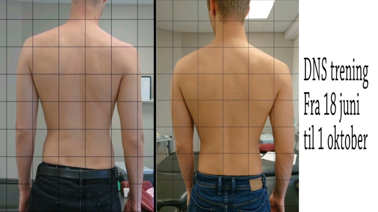 Dynamisk Nevromotorisk Stabilisering - en liten smakebit på hvordan jeg jobber med DNS på klinikken.