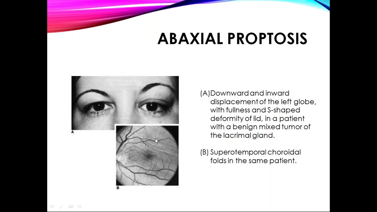 A Class On CLINICAL EVALUATION OF PROPTOSIS By Dr vivekanandu Dept Of Ophthalmololgy