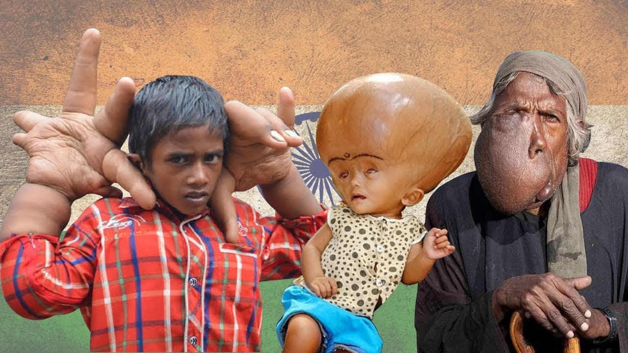Por que existem tantas pessoas com anomalias na &iacute;ndia?