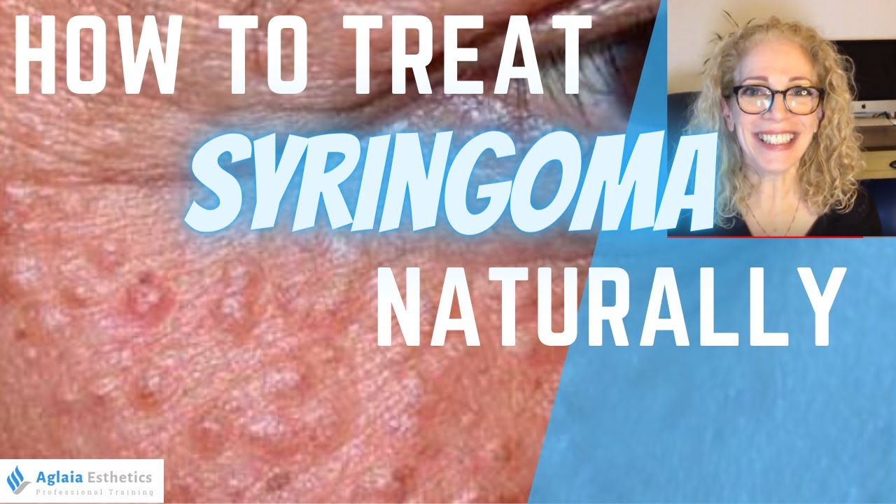 HOW TO TREAT SYRINGOMA (Natural Remedies & Medical Procedures)
