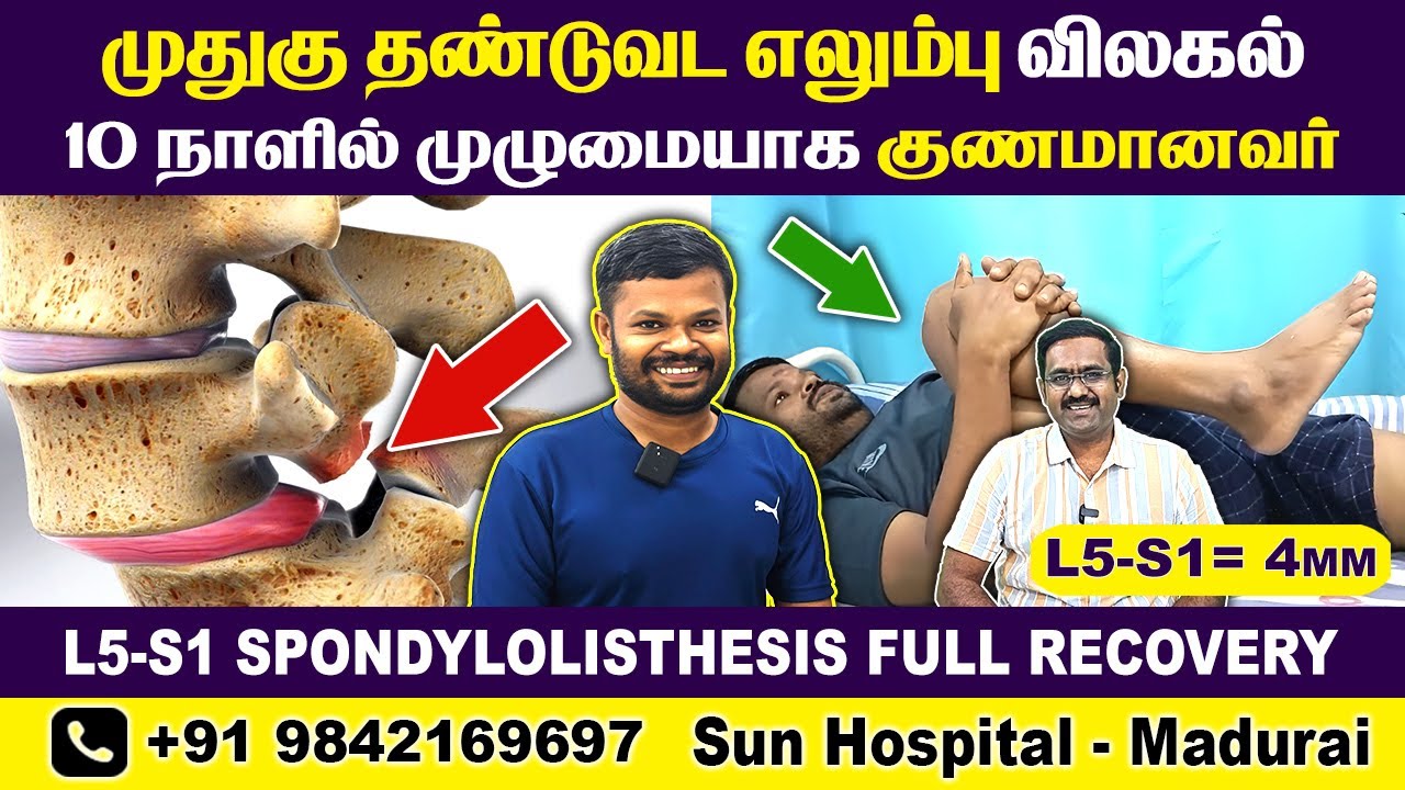 முதுகு தண்டுவட எலும்பு விலகல் 10 நாளில் முழுமையாக குணமானவர் 