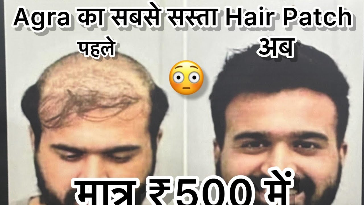 😍 इतना सस्ता hairpatch आपने कभी नहीं देखा होगा || Cheapest Hairpatch in Agra