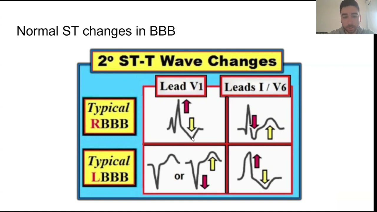 Bundle Branch Blocks