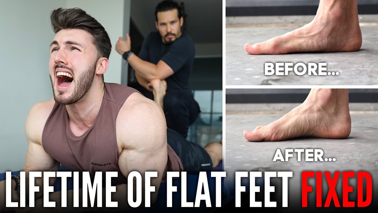 FIXING A LIFETIME OF FLAT FEET | Extremely Painful but Worth it...