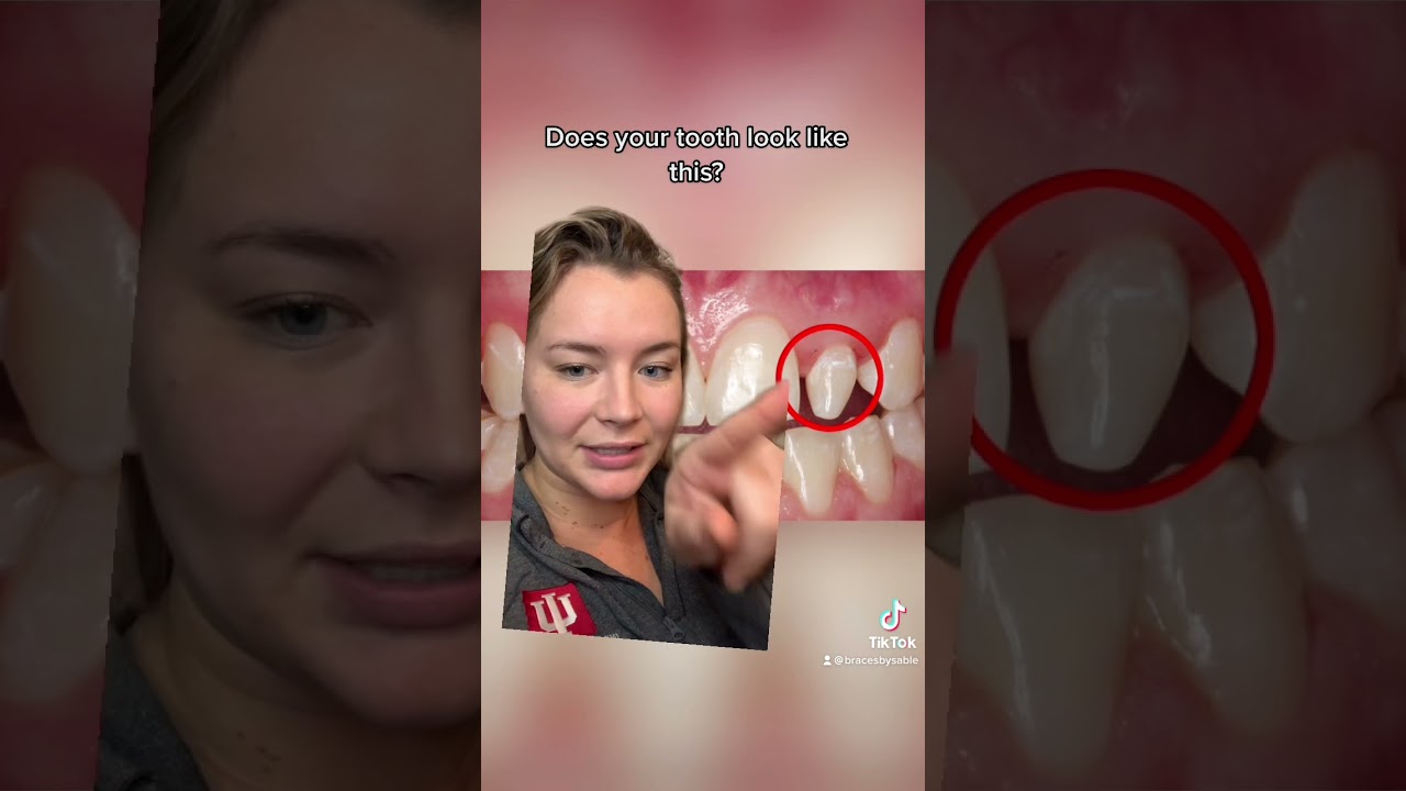 Боковые прищепки! #шорты #брекеты #ортодонт #боковые прищепки