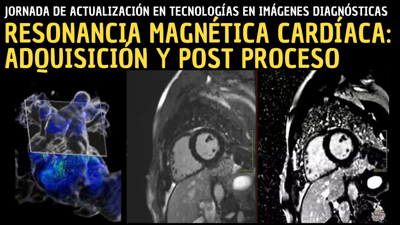 2da Jornada de actualización: Resonancia magnética cardíaca: Adquisición y post proceso.
