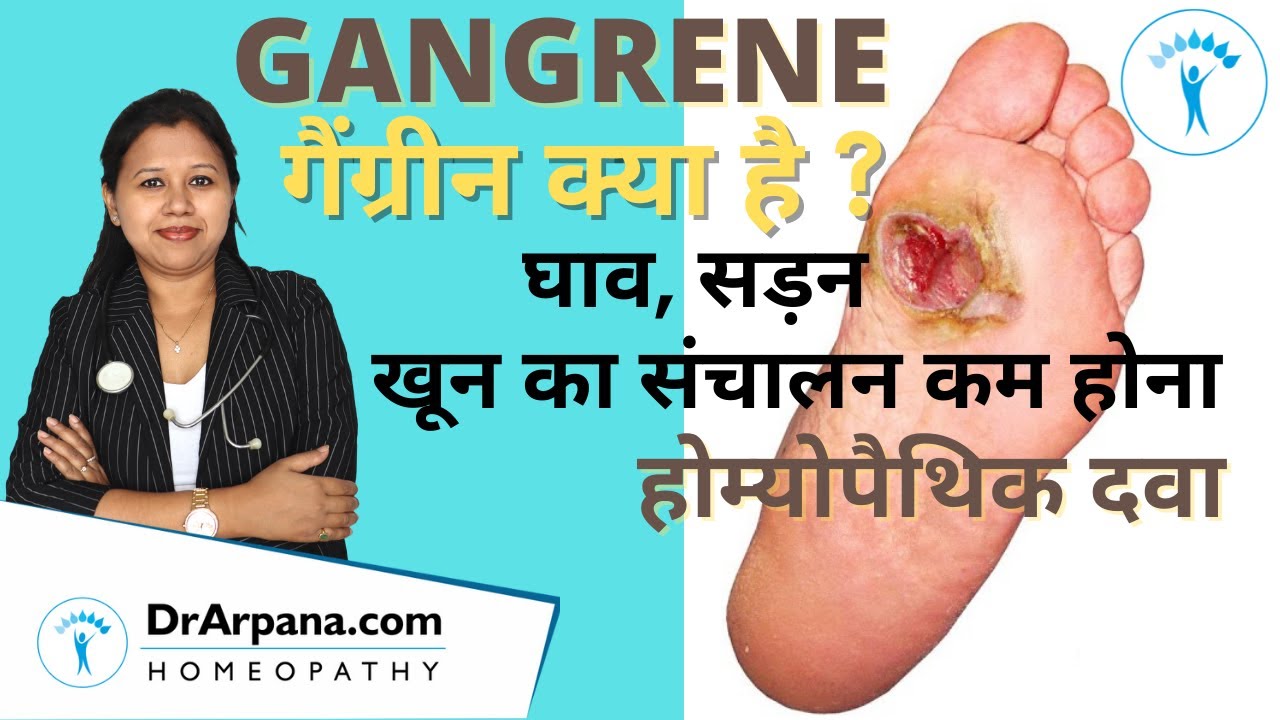 GANGRENE गैंग्रीन क्या है, कारन लक्षण व होम्योपैथिक दवा || Gangrene Types, Symptoms & Homeopathy