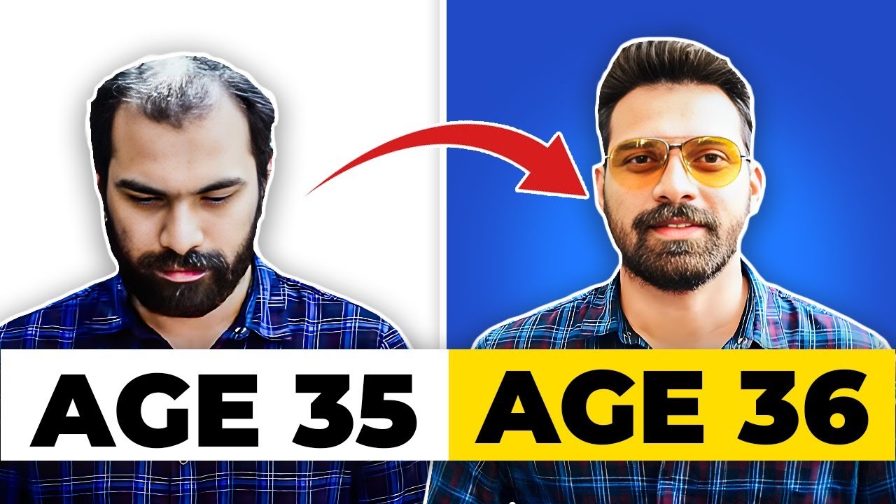 Complete Hair Transformation with a customized Hair Replacement System - Get 100% Natural Hairline