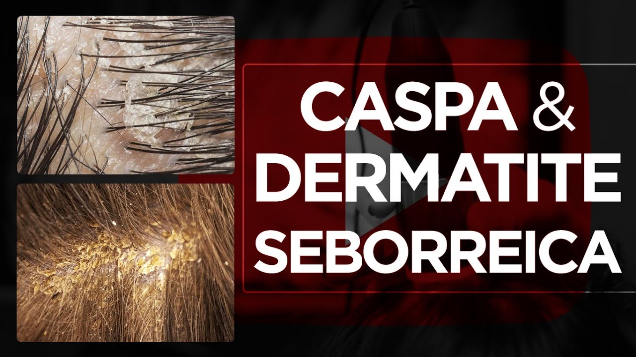 Dermatite seborreica e caspa - Terapia Capilar e Tricologia