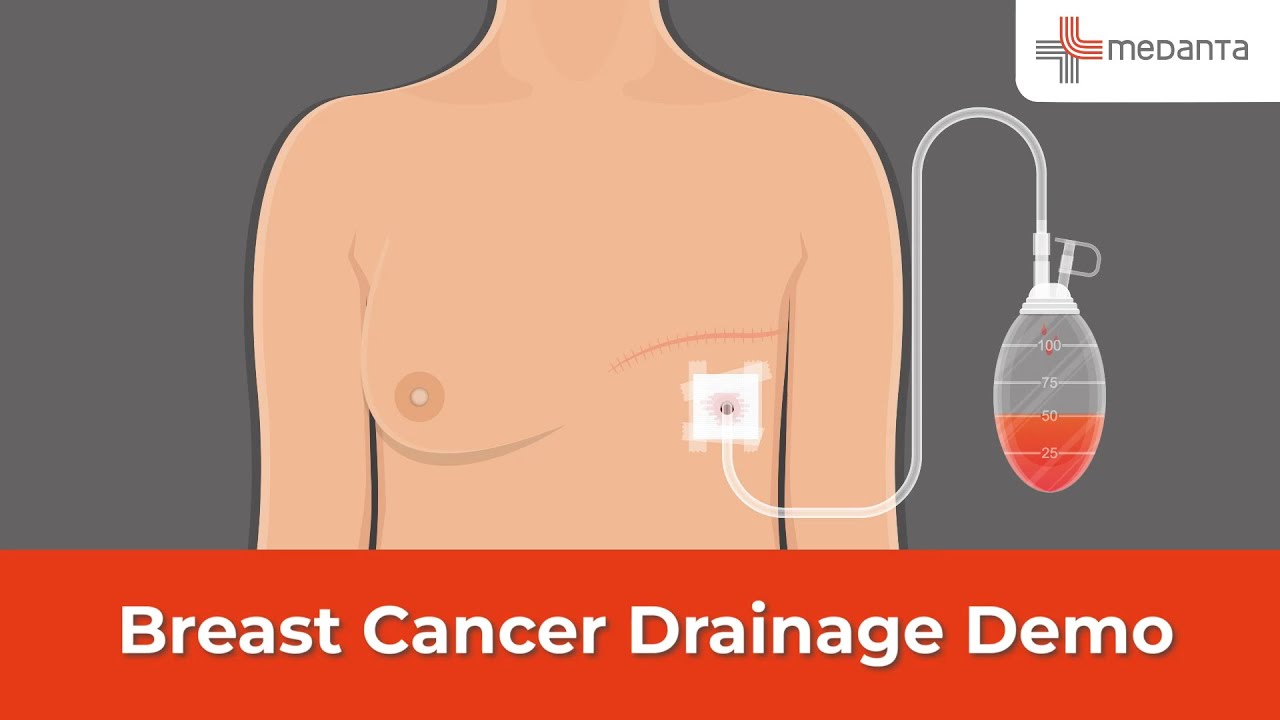 Demo of Using Breast Cancer Drainage After Surgery at Home (Hindi) | Dr. Kanchan Kaur | Medanta