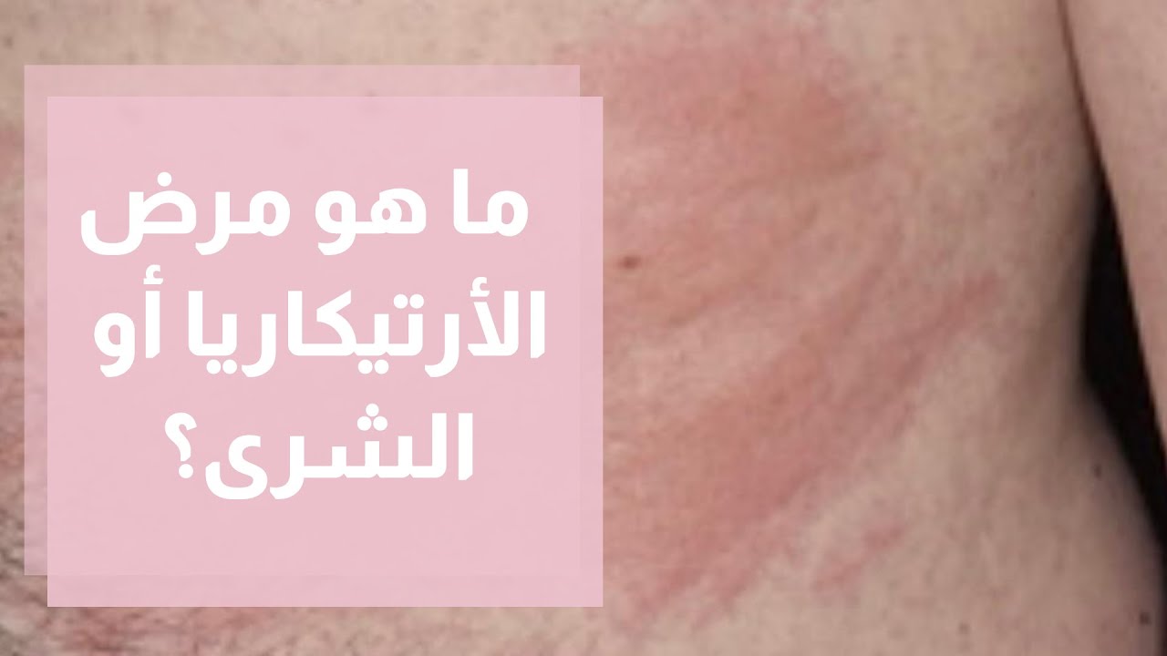 ما هو مرض الأرتيكاريا أو الشرى؟
