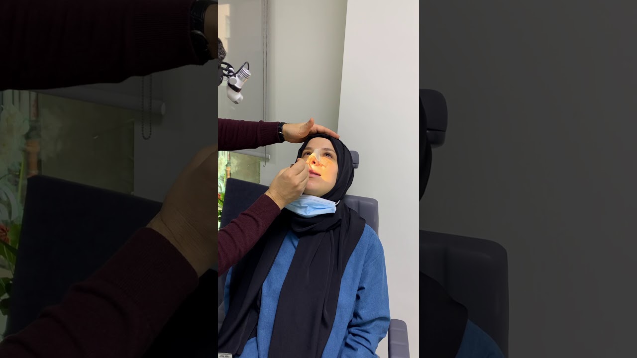 Burun estetiği sonrası silikon tampon &ccedil;ıkartılması #rhinoplasty#siliconsplint
