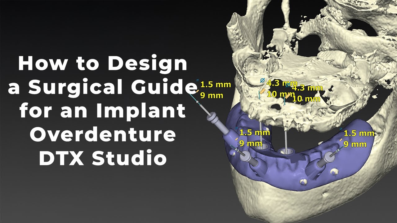 Planning and Designing a Surgical Guide for an Implant Overdenture in DTX Studio