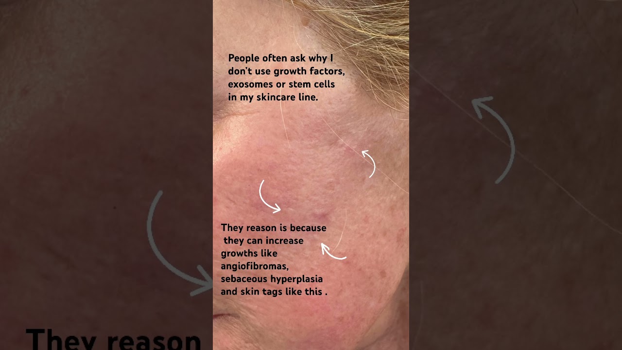 Why I don&rsquo;t like growth factors #growthfactors #exosomes #skincare #health