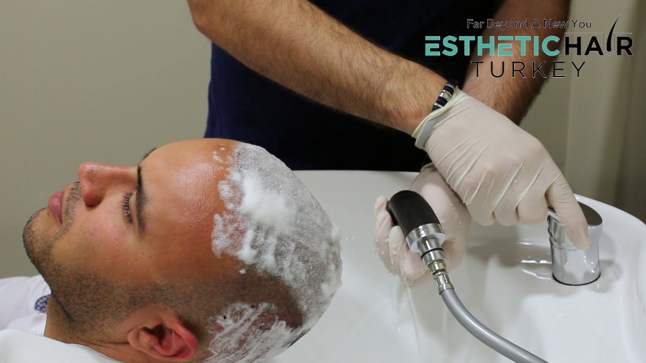 Hair wash after Hair Transplant