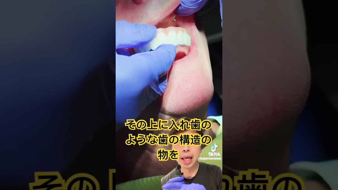 総入れ歯に変わるオールオン4とは？歯医者が解説🦷#shorts #ノンクラスプデンチャー