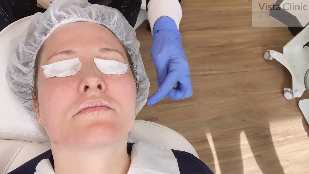 Protocol mandelic acid peel- training at the clinic