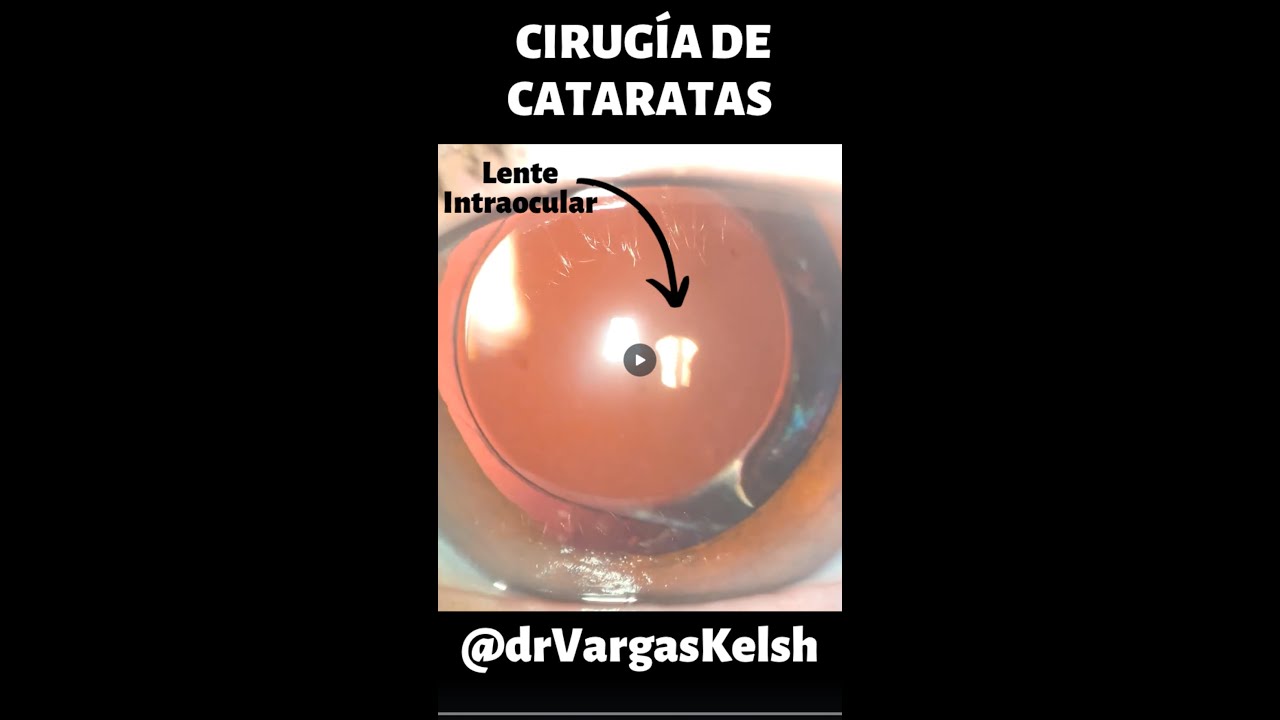 ✅ Cirugía de Cataratas ✅