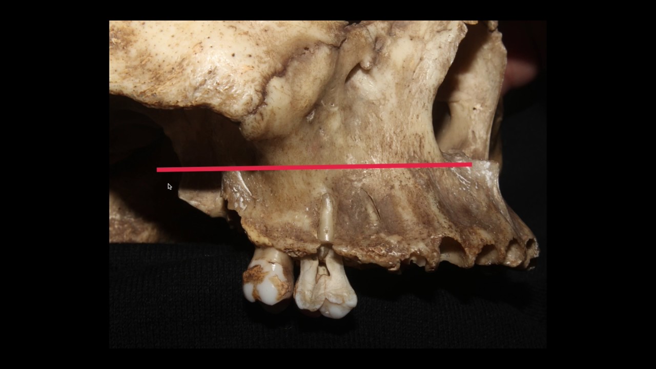 Fosas infratemporal y pterigopalatina