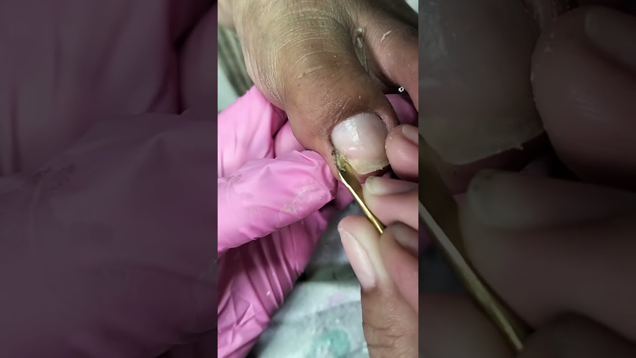 Pedicure | sk&oacute;rki | sucha sk&oacute;ra | usuwanie wrastających paznokci #wideo #paznokcie
